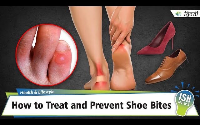 What to Do If You Have a Shoe Bite